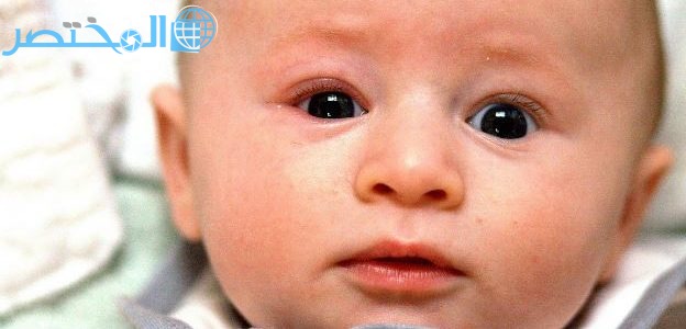 علاج التهاب العين عند الاطفال الرضع بالاعشاب - المختصر كوم